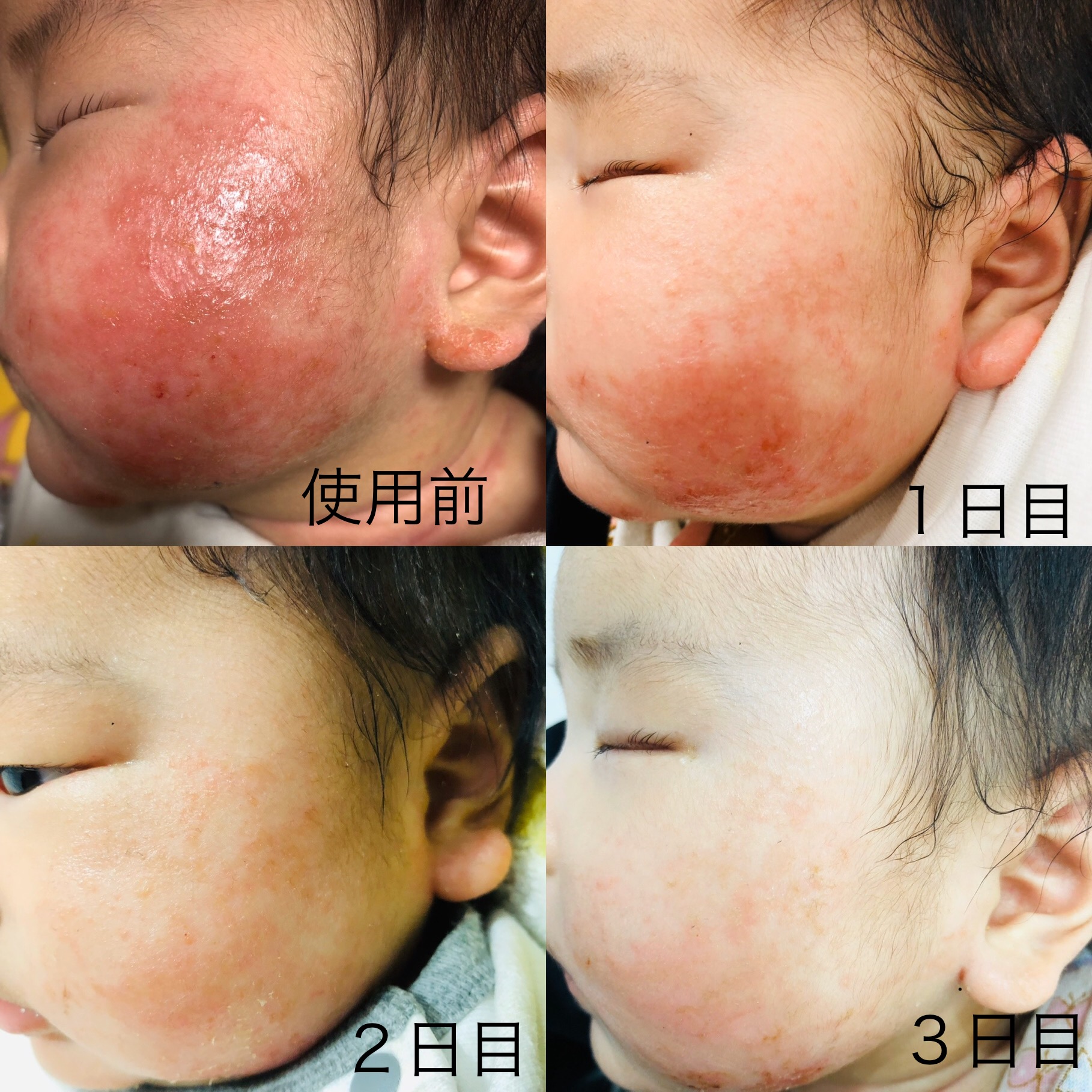乳児湿疹の改善 広島 カルミア美肌クリニック スタッフブログ