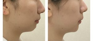 横顔綺麗になりませんか 広島 カルミア美肌クリニック スタッフブログ