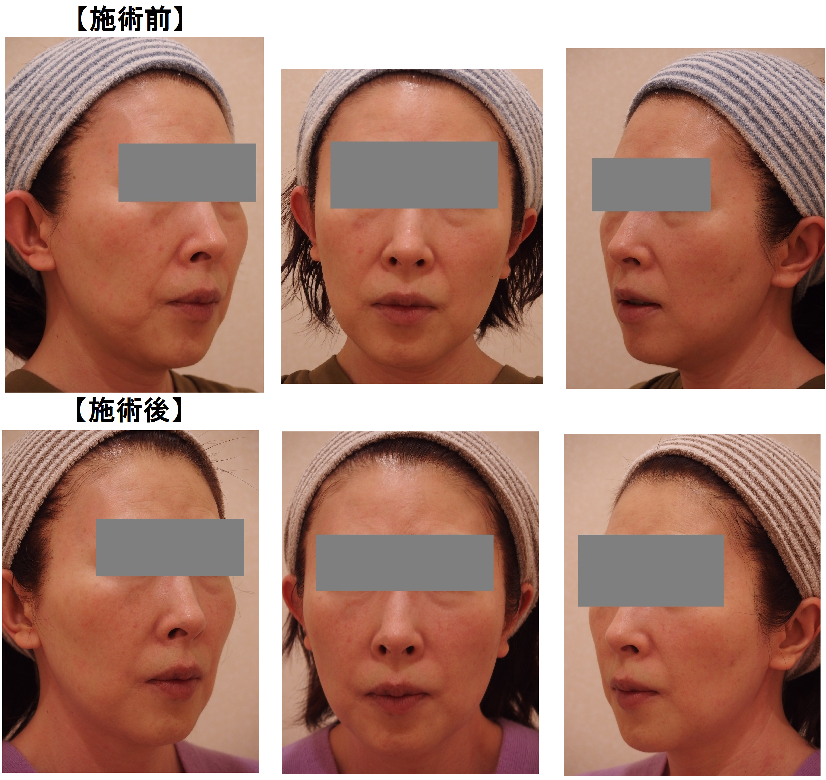 ヒアルロン酸2本での ほうれい線や顔全体の張り改善結果 カルミア美肌クリニック 院長の症例ブログ