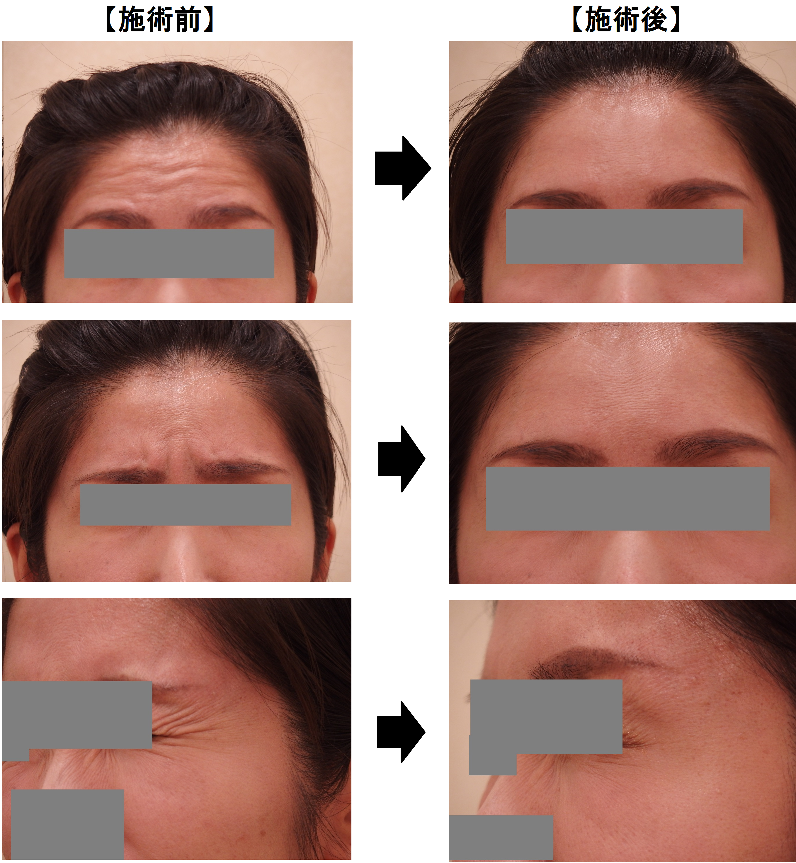 41歳の患者様 額 眉間 目尻のシワ改善 カルミア美肌クリニック 院長の症例ブログ