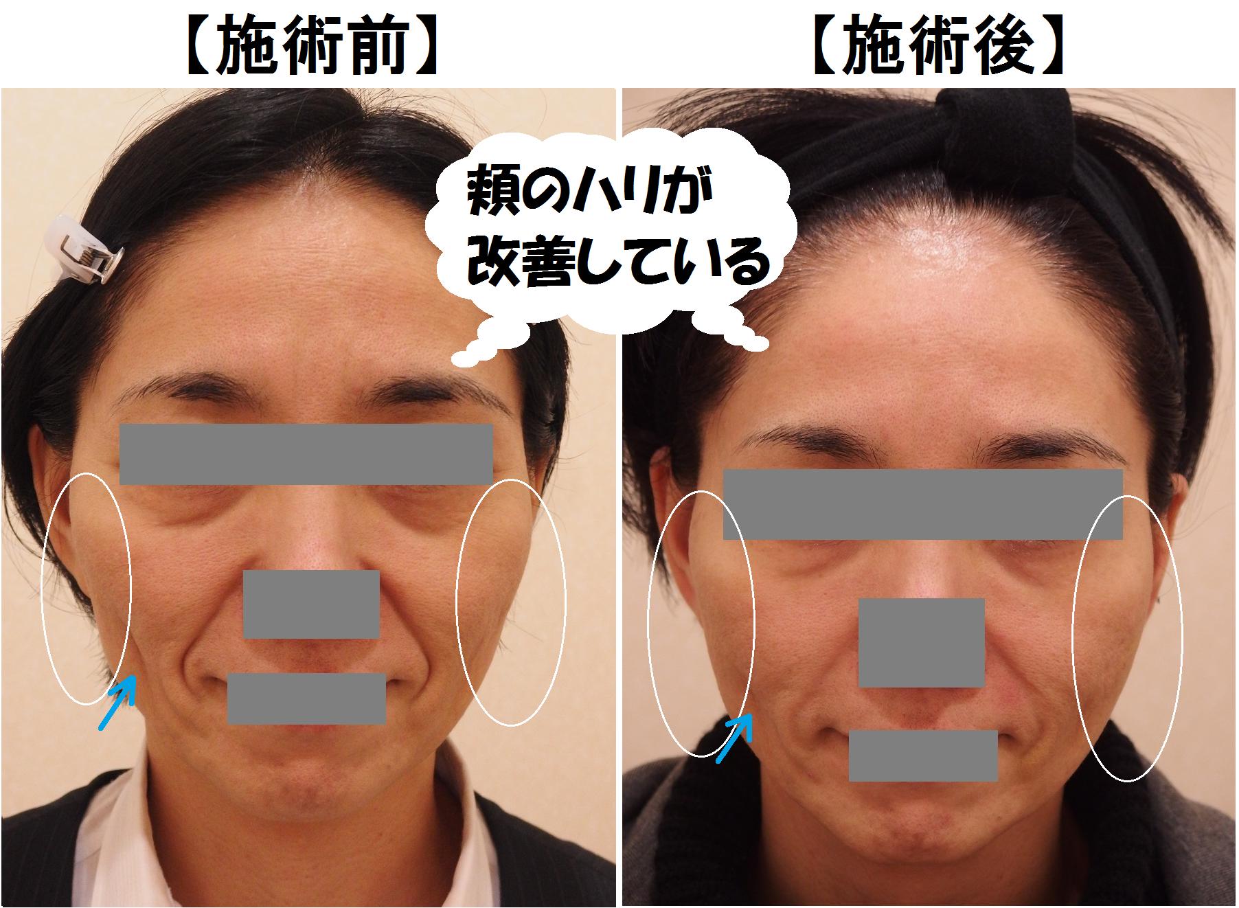 47歳の患者様 頬のこけ シワ改善による若返り カルミア美肌クリニック 院長の症例ブログ