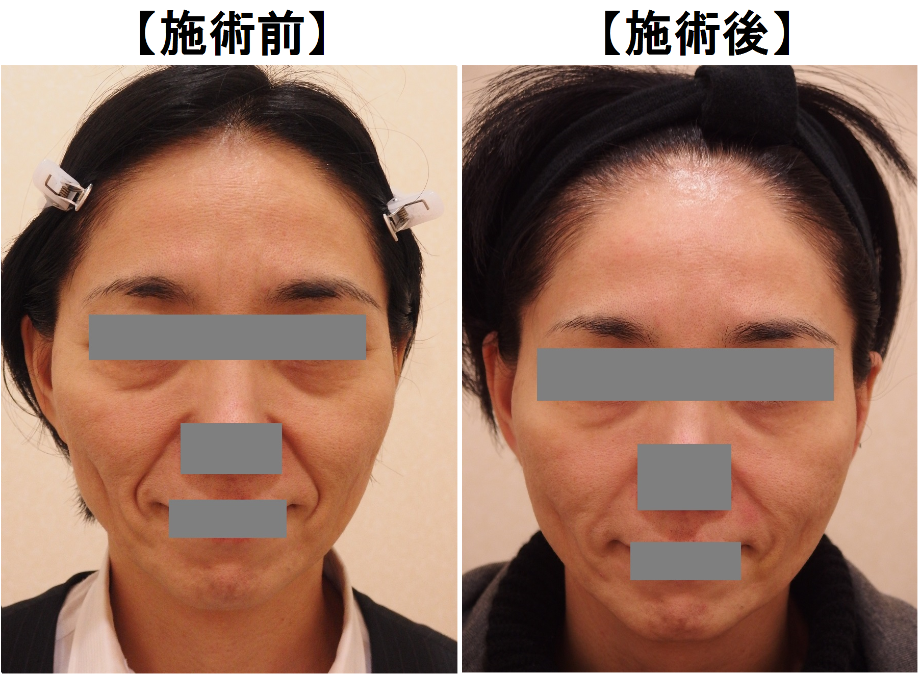 47歳の患者様 頬のこけ シワ改善による若返り カルミア美肌クリニック 院長の症例ブログ