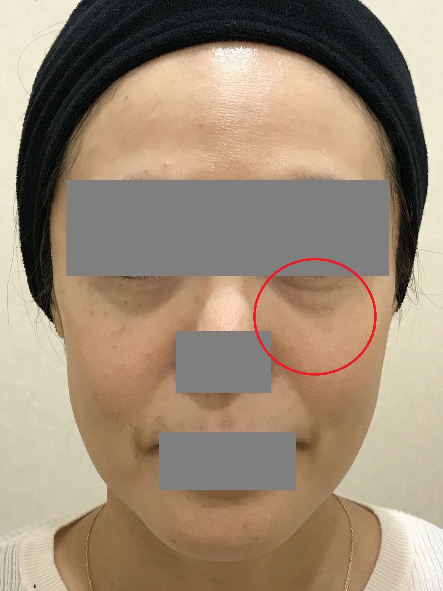 46歳の患者様 目元のクマ 頬の張りの改善 カルミア美肌クリニック 院長の症例ブログ
