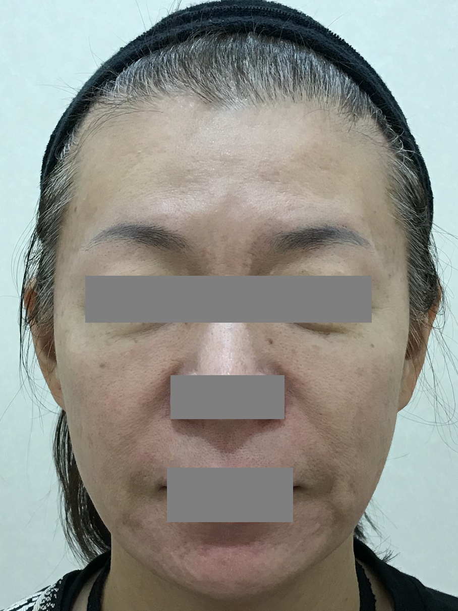 お顔の影は、老けて見える原因になる | カルミア美肌クリニック 院長の症例ブログ