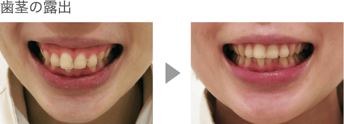 歯茎の露出