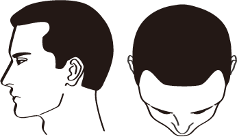 Ⅱ型